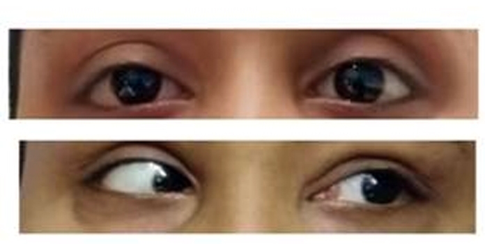 Rosai Dorfman_1 &nbs