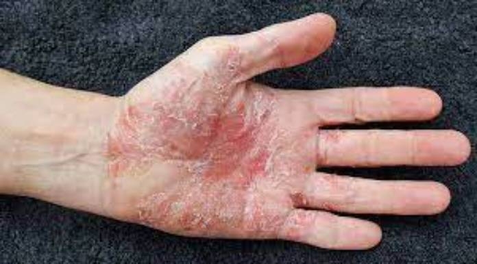 Article on Psoriasis Diagnosis and Treatment
