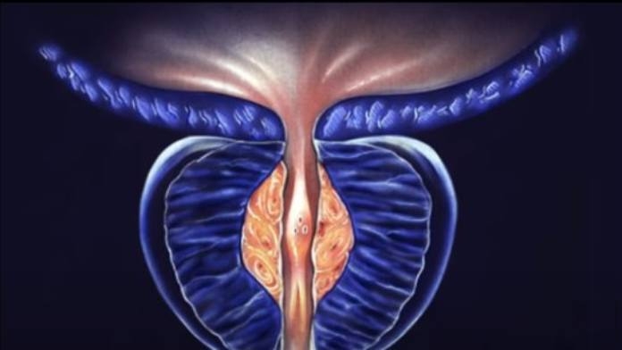 Article On Prostate hypertrophy