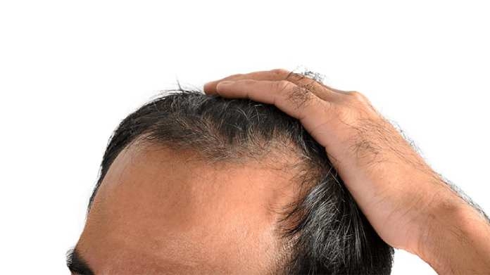 article on alopecia in Hair fall treatment