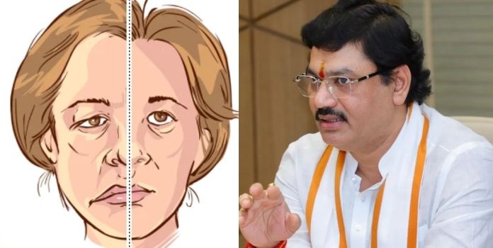 bell’s palsy disease symptoms and causes