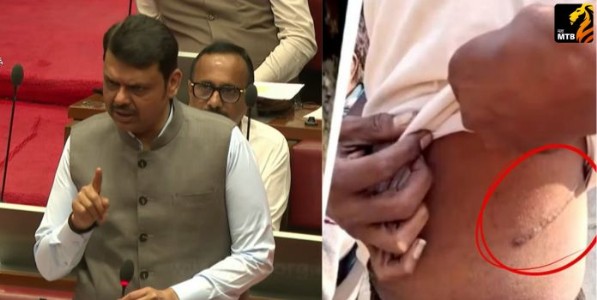 Farmer kidney sale case: सावकाराचे कर्ज फेडण्यासाठी शेतकऱ्याने विकली किडनी; सावकारांची संपत्ती गोठवण्याचे मुख्यमंत्र्यांचे निर्देश