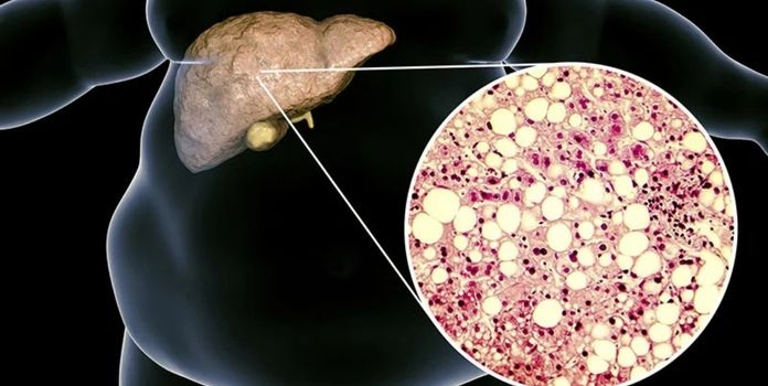 Fatty Liver Disease